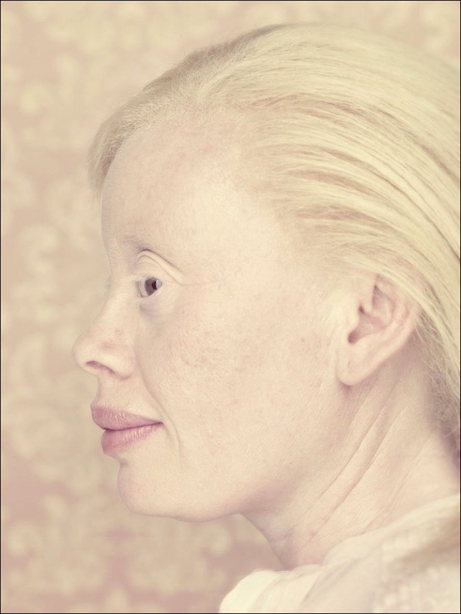 Albinos Project By Gustavo Lacerda