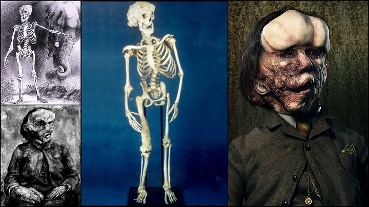 Elephant Man Neurofibromatosis