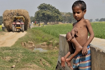 Indian boy with parasitic twin